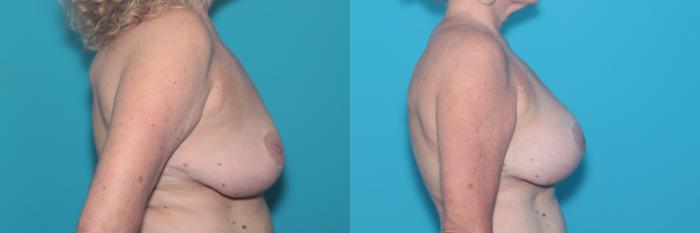 Before & After Breast Augmentation Case 442 Right Side View in West Des Moines & Ames, IA