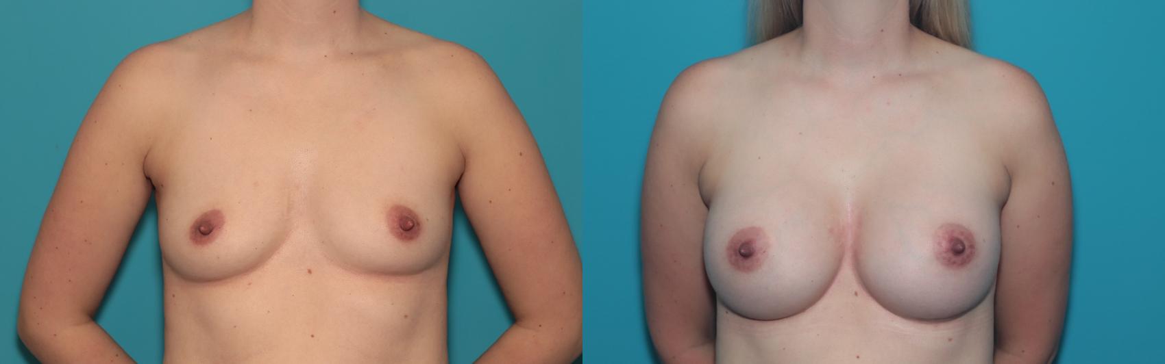 Before & After Breast Augmentation Case 449 Front View in West Des Moines & Ames, IA