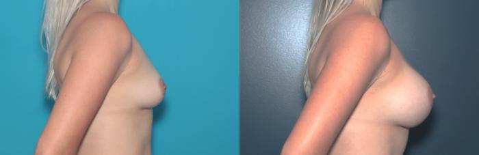 Before & After Breast Augmentation Case 477 Right Side View in West Des Moines & Ames, IA