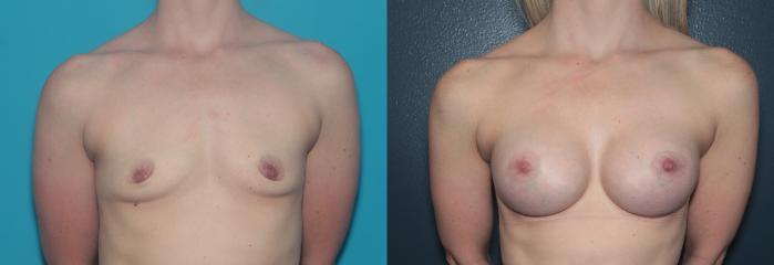 Before & After Breast Augmentation Case 482 Front View in West Des Moines & Ames, IA