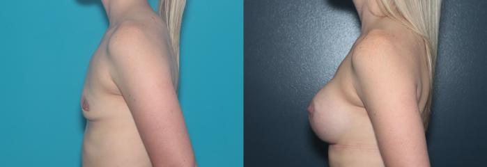 Before & After Breast Augmentation Case 482 Left Side View in West Des Moines & Ames, IA