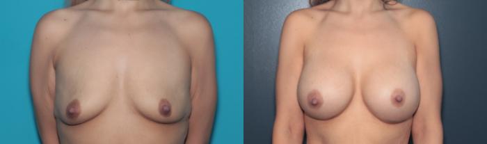 Before & After Breast Augmentation Case 486 Front View in West Des Moines & Ames, IA