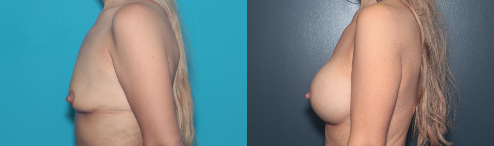 Before & After Breast Augmentation Case 486 Left Side View in West Des Moines & Ames, IA