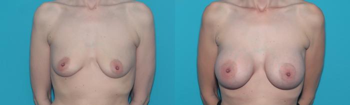 Before & After Breast Augmentation Case 487 Front View in West Des Moines & Ames, IA