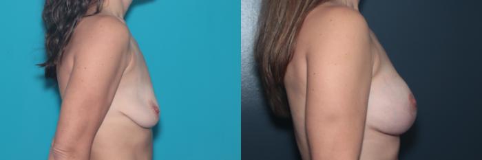 Before & After Breast Augmentation Case 491 Right Side View in West Des Moines & Ames, IA