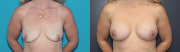 Before & After Breast Augmentation Case 504 Front View in West Des Moines & Ames, IA