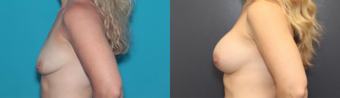 Before & After Breast Augmentation Case 504 Left Side View in West Des Moines & Ames, IA