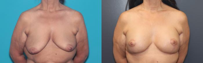 Before & After Breast Augmentation Case 507 Front View in West Des Moines & Ames, IA