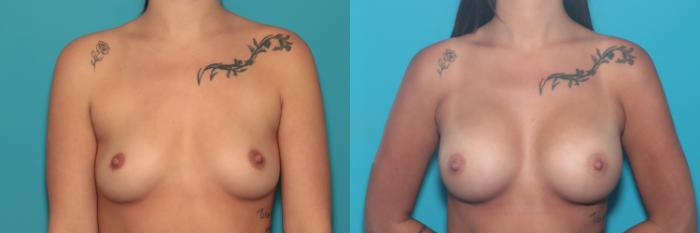 Before & After Breast Augmentation Case 529 Front View in West Des Moines & Ames, IA