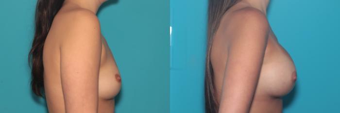 Before & After Breast Augmentation Case 529 Right Side View in West Des Moines & Ames, IA
