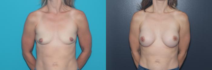 Before & After Breast Augmentation Case 530 Front View in West Des Moines & Ames, IA