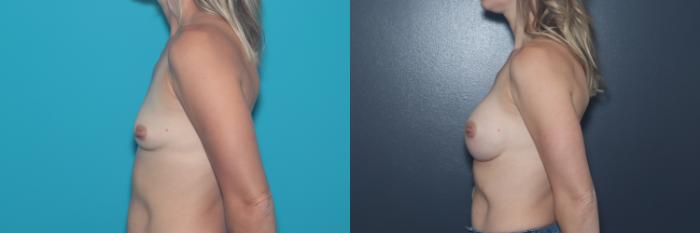Before & After Breast Augmentation Case 530 Left Side View in West Des Moines & Ames, IA