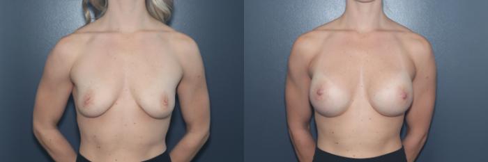 Before & After Breast Augmentation Case 538 Front View in West Des Moines & Ames, IA