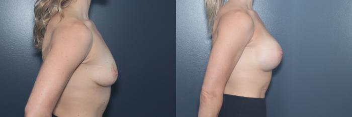 Before & After Breast Augmentation Case 538 Right Side View in West Des Moines & Ames, IA