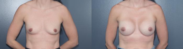 Before & After Breast Augmentation Case 543 Front View in West Des Moines & Ames, IA