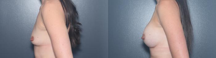 Before & After Breast Augmentation Case 543 Left Side View in West Des Moines & Ames, IA