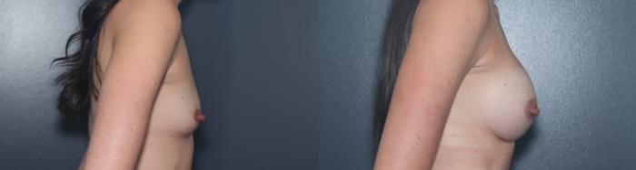Before & After Breast Augmentation Case 543 Right Side View in West Des Moines & Ames, IA