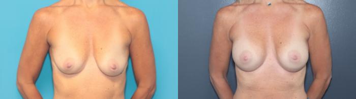 Before & After Breast Augmentation Case 545 Front View in West Des Moines & Ames, IA