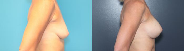 Before & After Breast Augmentation Case 545 Left Side View in West Des Moines & Ames, IA