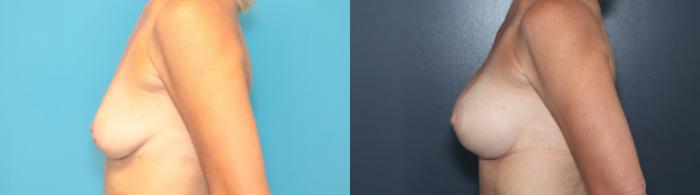 Before & After Breast Augmentation Case 545 Right Side View in West Des Moines & Ames, IA