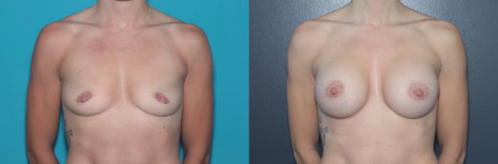 Before & After Breast Augmentation Case 547 Front View in West Des Moines & Ames, IA