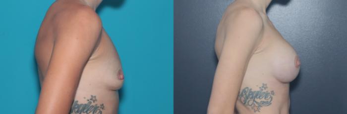 Before & After Breast Augmentation Case 547 Right Side View in West Des Moines & Ames, IA