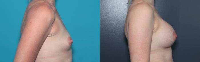 Before & After Breast Augmentation Case 548 Right Side View in West Des Moines & Ames, IA