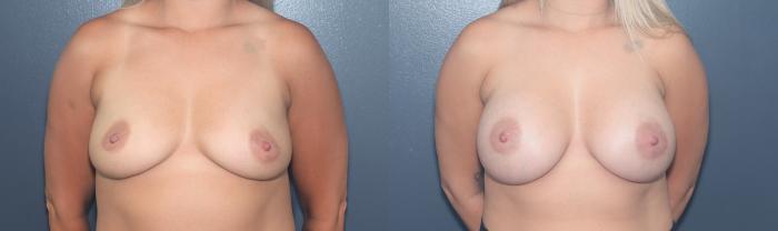 Before & After Breast Augmentation Case 581 Front View in West Des Moines & Ames, IA