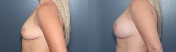 Before & After Breast Augmentation Case 581 Right Side View in West Des Moines & Ames, IA