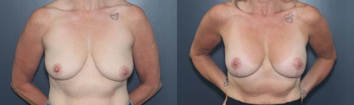 Before & After Breast Augmentation Case 582 Front View in West Des Moines & Ames, IA