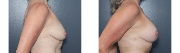 Before & After Breast Augmentation Case 582 Left Side View in West Des Moines & Ames, IA