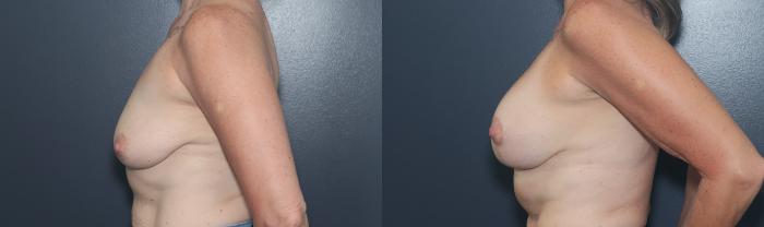 Before & After Breast Augmentation Case 582 Right Side View in West Des Moines & Ames, IA