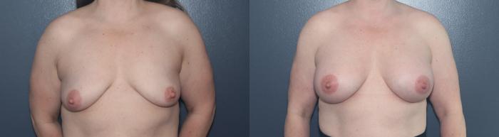Before & After Breast Augmentation Case 583 Front View in West Des Moines & Ames, IA