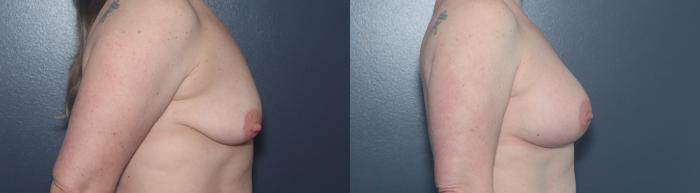 Before & After Breast Augmentation Case 583 Right Side View in West Des Moines & Ames, IA