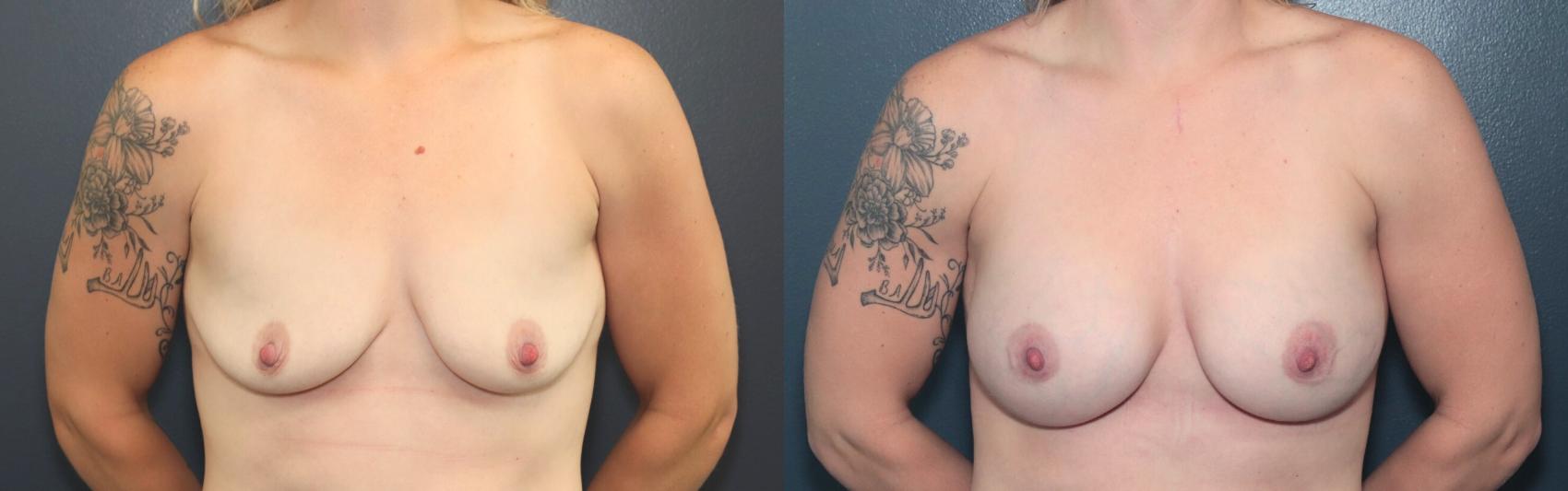 Before & After Breast Augmentation Case 587 Front View in West Des Moines & Ames, IA