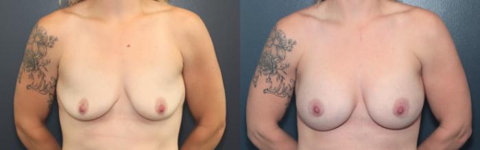 Before & After Breast Augmentation Case 587 Front View in West Des Moines & Ames, IA
