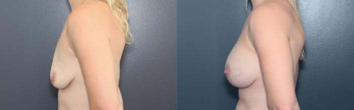 Before & After Breast Augmentation Case 587 Left Side View in West Des Moines & Ames, IA