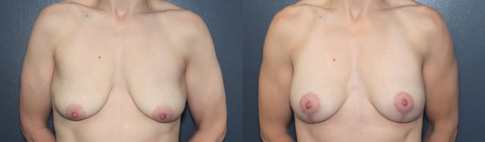 Before & After Breast Augmentation Case 588 Front View in West Des Moines & Ames, IA