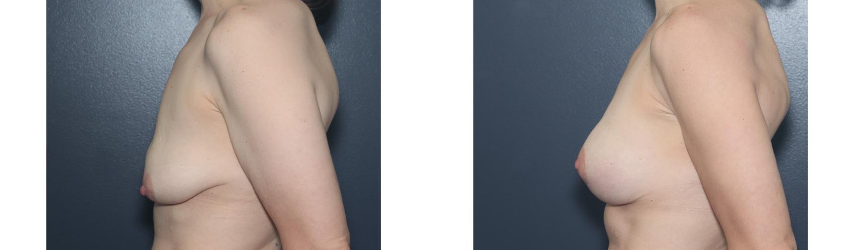 Before & After Breast Augmentation Case 588 Left Side View in West Des Moines & Ames, IA