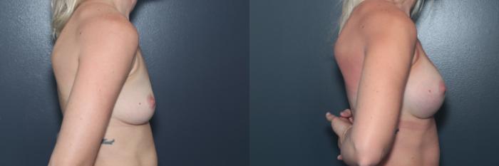 Before & After Breast Augmentation Case 594 Right Side View in West Des Moines & Ames, IA