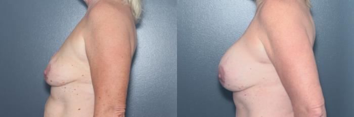 Before & After Breast Augmentation Case 601 Right Side View in West Des Moines & Ames, IA