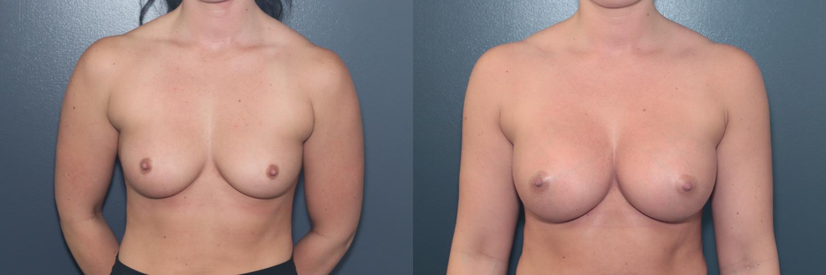 Before & After Breast Augmentation Case 610 Front View in West Des Moines & Ames, IA