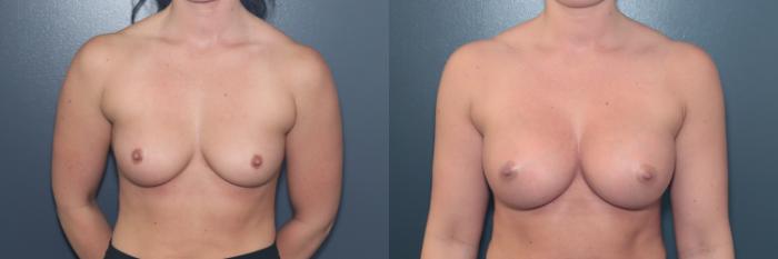 Before & After Breast Augmentation Case 610 Front View in West Des Moines & Ames, IA