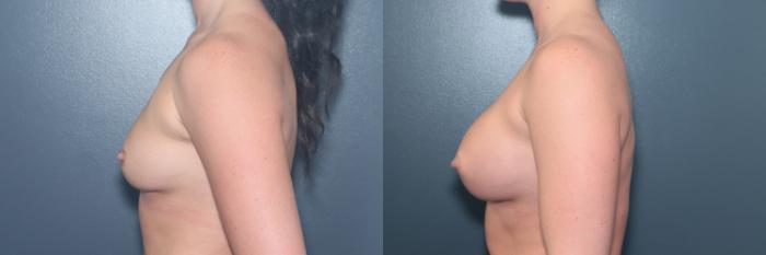 Before & After Breast Augmentation Case 610 Right Side View in West Des Moines & Ames, IA