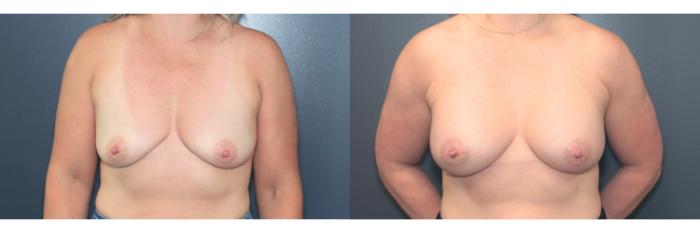 Before & After Breast Augmentation Case 611 Front View in West Des Moines & Ames, IA
