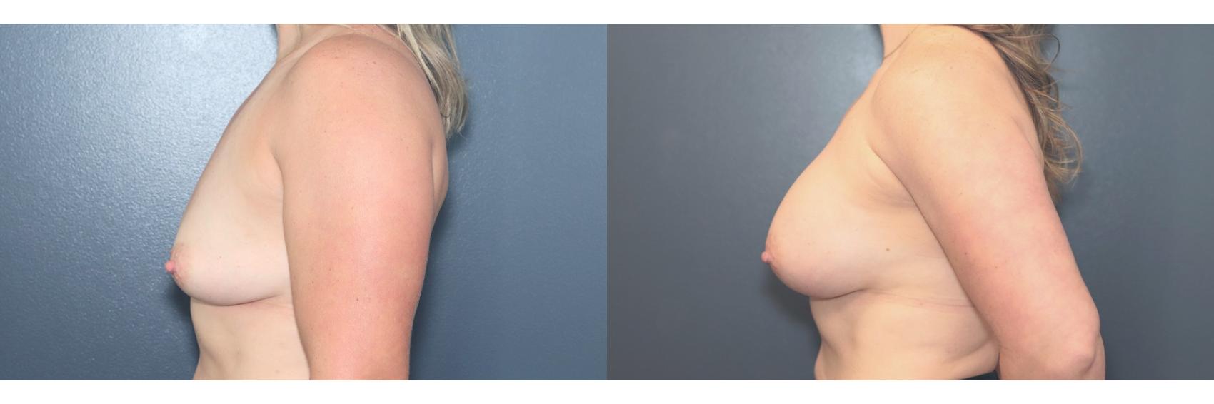 Before & After Breast Augmentation Case 611 Right Side View in West Des Moines & Ames, IA