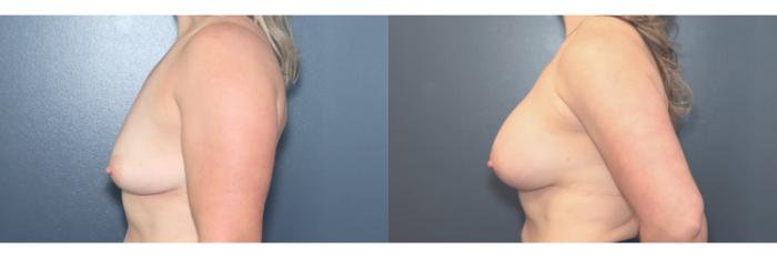 Before & After Breast Augmentation Case 611 Right Side View in West Des Moines & Ames, IA