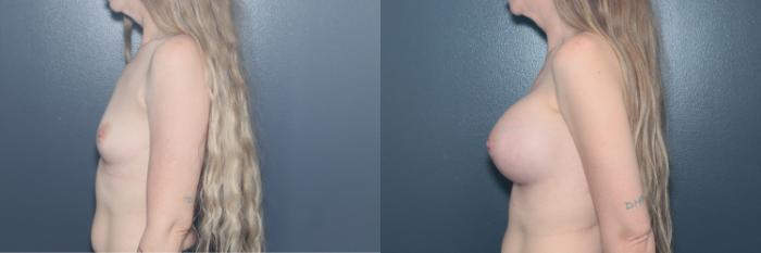 Before & After Breast Augmentation Case 612 Right Side View in West Des Moines & Ames, IA