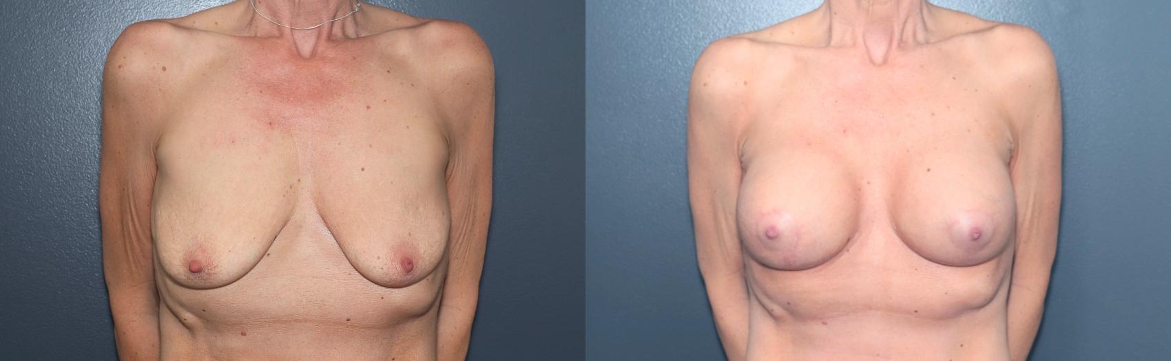 Before & After Breast Augmentation Case 615 Front View in West Des Moines & Ames, IA