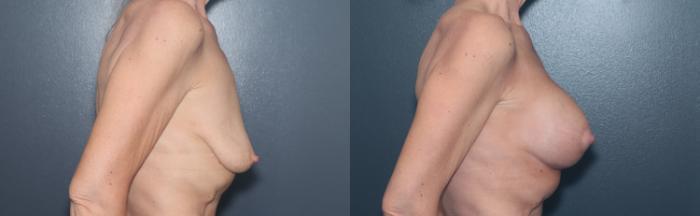 Before & After Breast Augmentation Case 615 Left Side View in West Des Moines & Ames, IA